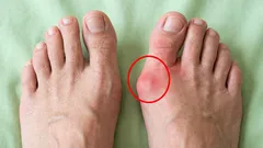 Recite zbogom kostima stopala: 6 vježbi koje će vam opustiti stopala